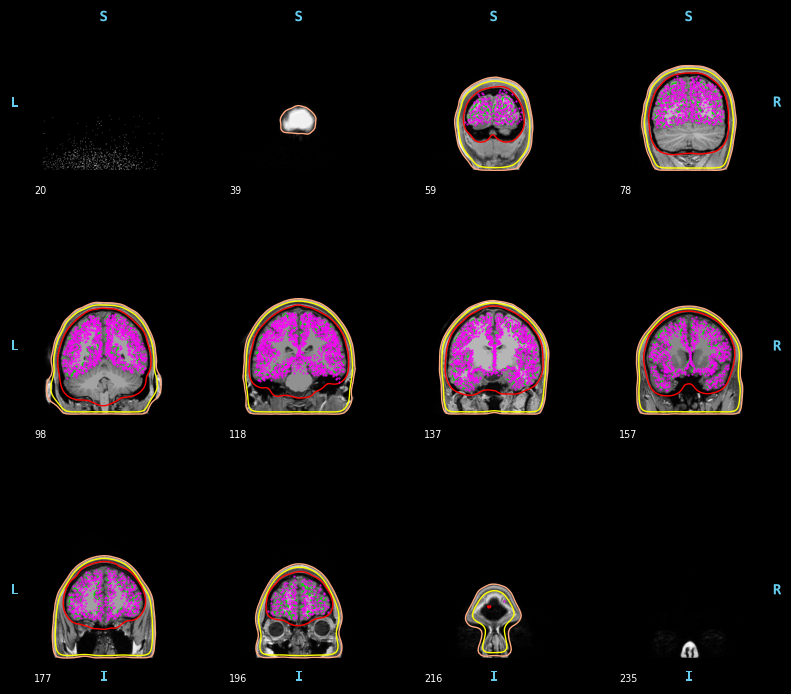 ../../../_images/6-meg-pipeline-gallery_notebooks_mne_mne_kit_computing_bem_model_20_3.png